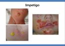 Common skin rashes in children, 소아 피부 발진 14페이지