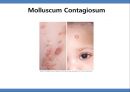 Common skin rashes in children, 소아 피부 발진 18페이지