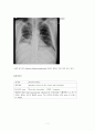 pleural effusion 흉막삼출증 케이스, 흉수 케이스, 흉막삼출증 간호과정, pleural effusion 케이스, 흉막삼출증 사례연구 7페이지