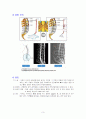 척추관협착증 케이스 스터디 A+ 5페이지