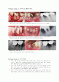 치아편측절제술 (tooth hemisection) 5페이지