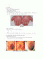 이식편대숙주병 4페이지