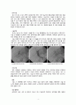 성인간호학 실습 담관염(cholangitis) 케이스스터디 자료 A+ 6페이지