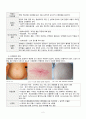 성인간호학 A+  알콜성 간경화  alcoholic liver cirrhosis  대상자에 맞게끔 간호과정을 했다고 칭찬받은 자료 간호진단3개 3페이지