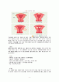 여성간호학 임상실습 자궁근종 케이스자궁근종 간호과정myoma uterus case study A+ 4페이지