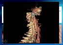 Carotid Angio CT에서 Jugular Vein Contrast Non Filling Method의 유용성 평가 5페이지