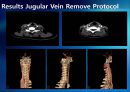 Carotid Angio CT에서 Jugular Vein Contrast Non Filling Method의 유용성 평가 12페이지