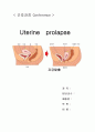 자궁탈출 uterine prolapse 간호진단  간호과정 모성 AA레포트 1페이지