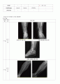 성인간호학 OS컨퍼런스 에이플자료(골절) 15페이지