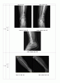 성인간호학 OS컨퍼런스 에이플자료(골절) 16페이지