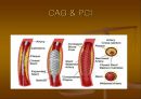 CAG (coronary angiography).ppt 25페이지