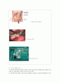 담낭용종제거술 laparoscopic cholecystectomy case 6페이지