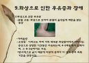 화상 (BURNS) - 화상의 발생빈도 원인 위험요인 진단 종류 27페이지