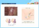 아동간호학 - 잠복고환 조별과제 ppt 5페이지