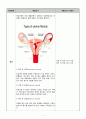 [모성간호학] OBGY, huge myoma uteri 자궁근종제거 케이스스터디 (완전 상세히 기술) 4페이지