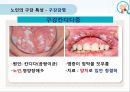 누인구강관리교육,노인의구강특성,노인의구강관리방법,올바른의치관리법,구강건조증 6페이지