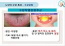 누인구강관리교육,노인의구강특성,노인의구강관리방법,올바른의치관리법,구강건조증 7페이지