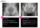 요추-골반의 방사선(x-ray) 분석법 8페이지