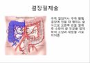 대장암의 진단 & 수술적 치료종류 12페이지