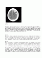 성인간호학실습 케이스스터디 [ 경막하 혈종(SDH) ]  4페이지