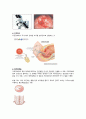 여성간호실습 자궁근종(uterine myoma), 자궁경부암(cervical cancer) 질병고찰(질병연구, 질병보고서, 문헌고찰) A+ 12페이지