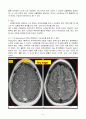 Moyamoya, Cerebral infarction (모야모야병, 뇌경색) 6페이지