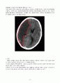 Moyamoya, Cerebral infarction (모야모야병, 뇌경색) 15페이지