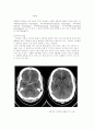 뇌출혈 (cerebral hemorrhage)  1페이지