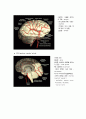 뇌출혈(stroke) 7페이지