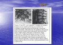 요통(Herniated disk)의 발생 원인과 증상 그리고 효과적인 치료방법 51페이지