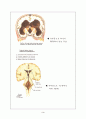 뇌수종(수두증-Hydrocephalus) 3페이지