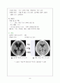 뇌수종(수두증-Hydrocephalus) 5페이지
