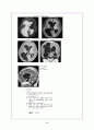 뇌수종(수두증-Hydrocephalus) 6페이지