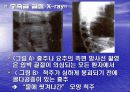 골다공증에 프리젠테이션을 위한 완벽 ppt자료! 19페이지