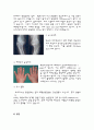 (골 관절염)퇴행성관절염으로 인해 실시한 인공 슬관절 치환술  Case Study 4페이지