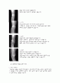(골 관절염)퇴행성관절염으로 인해 실시한 인공 슬관절 치환술  Case Study 6페이지