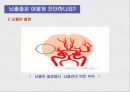 뇌혈관사고, 뇌졸중 20페이지