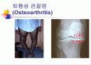 무릎 관절염의 진단과 치료 4페이지