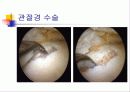 무릎 관절염의 진단과 치료 20페이지