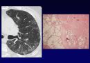 Idiopathic Interstitial Pneumonia 12페이지