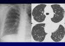 Idiopathic Interstitial Pneumonia 13페이지