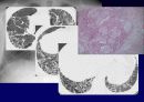 Idiopathic Interstitial Pneumonia 14페이지