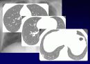 Idiopathic Interstitial Pneumonia 15페이지