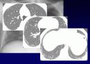 Idiopathic Interstitial Pneumonia 16페이지