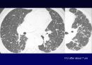 Idiopathic Interstitial Pneumonia 17페이지