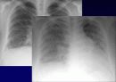 Idiopathic Interstitial Pneumonia 19페이지