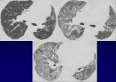 Idiopathic Interstitial Pneumonia 20페이지