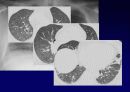 Idiopathic Interstitial Pneumonia 27페이지