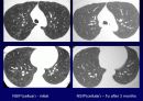 Idiopathic Interstitial Pneumonia 28페이지