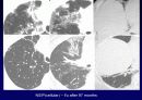 Idiopathic Interstitial Pneumonia 29페이지